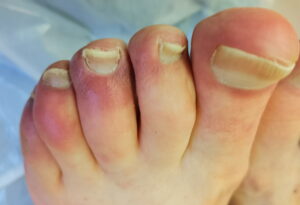Chilblain like lesions NEWS from the Society of Shoe Fitters and Children’s Foot Health Register